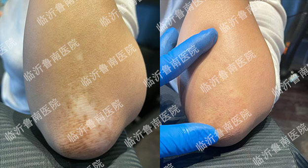 1白癜风会隐身术怎么办 3个法宝一网打尽&nbsp;临沂皮肤病医院哪家好