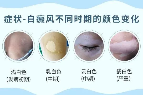 14白癜风白斑发展到瓷白阶段到底需要多少年&nbsp;临沂皮肤科最好的医院