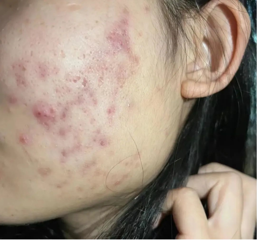 痤疮1