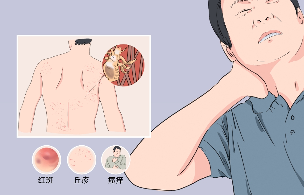 瘙痒